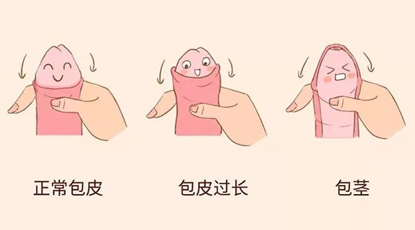 包裹与绽放：解读包茎与包皮过长.jpg